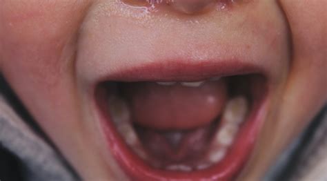 Blåsor i munnen barn feber